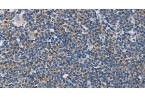 Immunohistochemistry of paraffin-embedded Human lymphoma tissue using NEK5 Polyclonal Antibody at dilution 1:60 (NEK5 抗体)