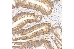 Immunohistochemistry of paraffin-embedded human colon carcinoma using eIF1A Rabbit mAb (ABIN7267027) at dilution of 1:50 (40x lens). (Eukaryotic Translation Initiation Factor 1A (EIF1A) 抗体)