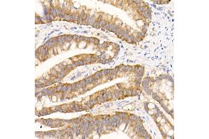 Immunohistochemistry of paraffin-embedded human colon carcinoma using eIF1A Rabbit mAb (ABIN7267027) at dilution of 1:50 (40x lens).