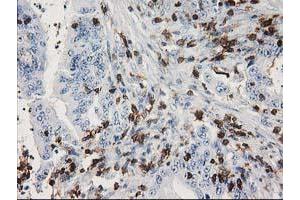 Immunohistochemical staining of paraffin-embedded Adenocarcinoma of Human colon tissue using anti-DEF8 mouse monoclonal antibody. (DEF8 抗体)