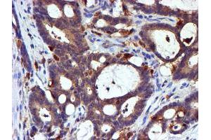 Immunohistochemical staining of paraffin-embedded Adenocarcinoma of Human colon tissue using anti-LIMK1 mouse monoclonal antibody. (LIM Domain Kinase 1 抗体)