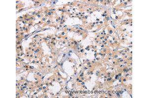 Immunohistochemistry of Human thyroid cancer using SENP1 Polyclonal Antibody at dilution of 1:25 (SENP1 抗体)