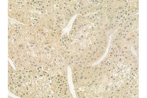 ABIN6259798 and ABIN6277719 at 1/100 staining human hepatocellular carcinoma by IHC-P. (ADH6 抗体  (C-Term))