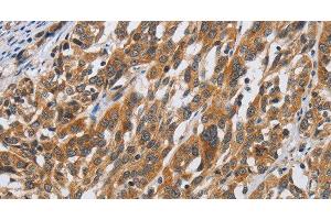 Immunohistochemistry of paraffin-embedded Human esophagus cancer tissue using DSP Polyclonal Antibody at dilution 1:40 (Desmoplakin 抗体)