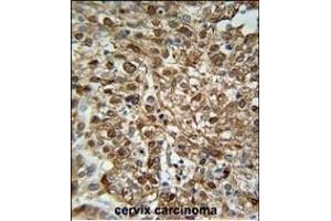 WDR43 Antibody (C-term) (ABIN651679 and ABIN2840356) immunohistochemistry analysis in formalin fixed and paraffin embedded human Cervix carcinoma followed by peroxidase conjugation of the secondary antibody and DAB staining. (WDR43 抗体  (C-Term))