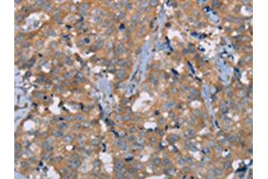 The image on the left is immunohistochemistry of paraffin-embedded Human breast cancer tissue using ABIN7191717(NRG3 Antibody) at dilution 1/30, on the right is treated with synthetic peptide. (Neuregulin 3 抗体)