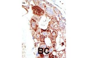 Formalin-fixed and paraffin-embedded human cancer tissue reacted with the primary antibody, which was peroxidase-conjugated to the secondary antibody, followed by DAB staining. (SENP6 抗体  (C-Term))