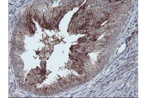 Immunohistochemical staining of paraffin-embedded Adenocarcinoma of Human endometrium tissue using anti-RLBP1 mouse monoclonal antibody. (RLBP1 抗体)