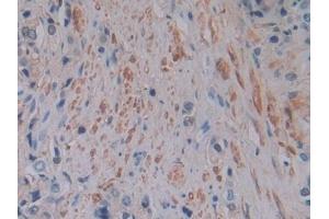 Detection of FTL in Human Prostate cancer Tissue using Polyclonal Antibody to Ferritin, Light Polypeptide (FTL) (FTL 抗体  (AA 2-175))