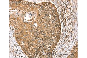 Immunohistochemistry of Human esophagus cancer using MORF4L1 Polyclonal Antibody at dilution of 1:35 (MORF4L1 抗体)