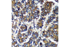 Immunohistochemistry of paraffin-embedded Human liver cancer using TMX2 Rabbit pAb (ABIN7270810) at dilution of 1:100 (40x lens). (TMX2 抗体  (AA 128-296))
