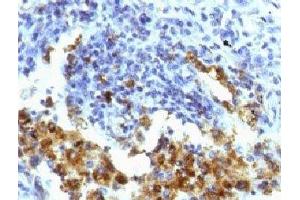 IHC testing of FFPE human lung adenocarcinoma with Napsin-A antibody (clone NPSNA-1). (NAPSA 抗体)