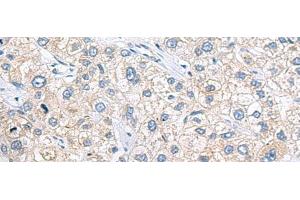 Immunohistochemistry of paraffin-embedded Human liver cancer tissue using ZNF35 Polyclonal Antibody at dilution of 1:40(x200) (ZNF35 抗体)