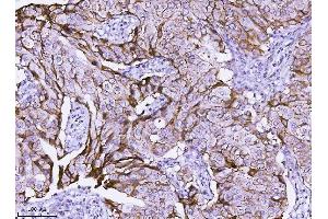 IHC analysis of ErbB 2 using anti-ErbB 2 antibody (ABIN5518830). (ErbB2/Her2 抗体  (N-Term))