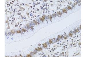 Immunohistochemistry of paraffin-embedded human gastric cancer using LMNB2 Antibody.