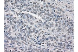 Immunohistochemical staining of paraffin-embedded Adenocarcinoma of breast tissue using anti-PPP5C mouse monoclonal antibody. (PP5 抗体)