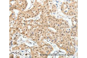 Immunohistochemistry of Human lung cancer using PAX7 Polyclonal Antibody at dilution of 1:35 (PAX7 抗体)