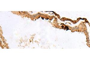 Immunohistochemistry of paraffin-embedded Human thyroid cancer tissue using RABGGTA Polyclonal Antibody at dilution of 1:50(x200) (RABGGTA 抗体)