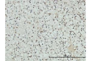Immunoperoxidase of monoclonal antibody to AR on formalin-fixed paraffin-embedded human renal cell carcinoma tissue. (Androgen Receptor 抗体  (AA 221-320))