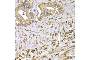 Immunohistochemistry of paraffin-embedded human liver cancer using FSCN1 antibody. (Fascin 抗体)