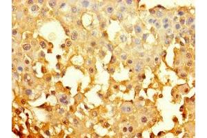 Immunohistochemistry of paraffin-embedded human breast cancer using ABIN7153625 at dilution of 1:100 (GJB6 抗体  (AA 216-261))