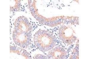 Immunohistochemistry of paraffin-embedded Human colon carcinoma using EIF4EBP1 Polyclonal Antibody at dilution of 1:100 (40x lens). (eIF4EBP1 抗体)