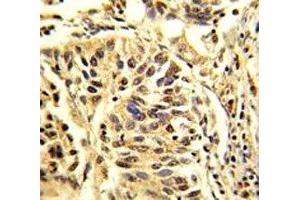 IHC analysis of FFPE human lung carcinoma stained with CEBPB antibody (CEBPB 抗体  (AA 271-298))
