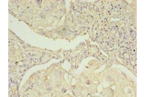 Immunohistochemistry of paraffin-embedded human lung cancer using ABIN7142288 at dilution of 1:100 (EBP 抗体  (AA 2-230))