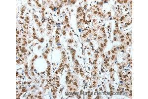 Immunohistochemistry of Human breast cancer using BNIP1 Polyclonal Antibody at dilution of 1:60