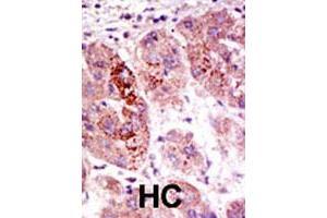 Formalin-fixed and paraffin-embedded human hepatocellular carcinoma tissue reacted with the USP7 polyclonal antibody  , which was peroxidase-conjugated to the secondary antibody, followed by AEC staining . (USP7 抗体  (C-Term))