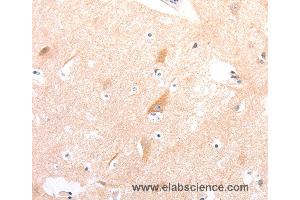 Immunohistochemistry of Human colon cancer using CELSR2 Polyclonal Antibody at dilution of 1:50 (CELSR2 抗体)