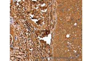 Immunohistochemistry of Human cervical cancer using CNN3 Polyclonal Antibody at dilution of 1:25 (CNN3 抗体)