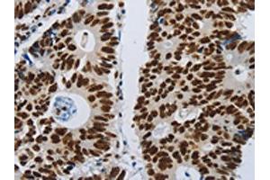 The image on the left is immunohistochemistry of paraffin-embedded Human colon cancer tissue using ABIN7192399(SLC16A14 Antibody) at dilution 1/80, on the right is treated with synthetic peptide. (SLC16A14 抗体)