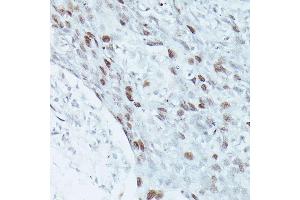 Immunohistochemistry of paraffin-embedded human breast cancer using MEF2C antibody (ABIN3023393, ABIN3023394, ABIN3023395 and ABIN6219695) at dilution of 1:100 (40x lens). (MEF2C 抗体  (AA 170-380))