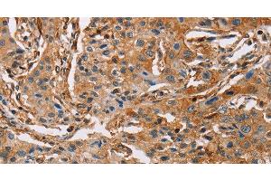 Immunohistochemistry of paraffin-embedded Human lung cancer using ACTA1 Polyclonal Antibody at dilution of 1:65 (Actin 抗体)