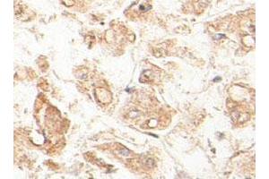 Immunohistochemical staining of formalin-fixed paraffin-embedded human fetal liver tissue showing cytoplasmic staining with ACAA1 polyclonal antibody  at 1 : 100 dilution. (ACAA1 抗体  (AA 210-424))