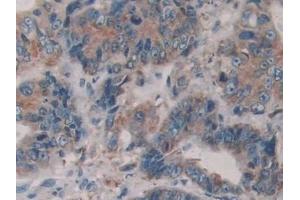 Detection of PDIA4 in Human Colorectal cancer Tissue using Polyclonal Antibody to Protein Disulfide Isomerase A4 (PDIA4) (PDIA4 抗体  (AA 505-636))