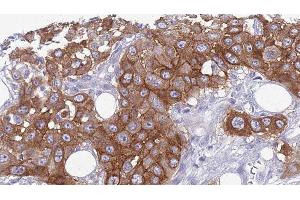 ABIN6275769 at 1/100 staining Human Head and neck cancer tissue by IHC-P.