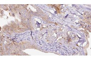 ABIN6273305 at 1/100 staining Human thyroid cancer tissue by IHC-P. (RAB3A 抗体  (N-Term))