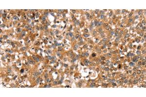 Immunohistochemistry of paraffin-embedded Human lung cancer using STAR Polyclonal Antibody at dilution of 1:35 (STAR 抗体)