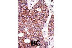 Formalin-fixed and paraffin-embedded human cancer tissue reacted with GCNT1 polyclonal antibody  , which was peroxidase-conjugated to the secondary antibody, followed by DAB staining . (GCNT1 抗体  (C-Term))