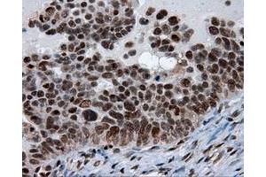 Immunohistochemical staining of paraffin-embedded Adenocarcinoma of breast tissue using anti-SIL1 mouse monoclonal antibody. (SIL1 抗体)