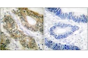Immunohistochemistry analysis of paraffin-embedded human colon carcinoma tissue, using SEPARASE (Ab-801) Antibody. (Separase 抗体  (AA 767-816))