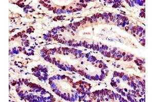 Immunohistochemistry of paraffin-embedded human colon cancer using ABIN7168587 at dilution of 1:100 (SPDEF/PSE 抗体  (AA 145-247))
