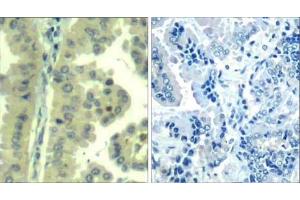 Immunohistochemical analysis of paraffin-embedded human lung carcinoma tissue using eIF4G (Ab-1232) Antibody (E021514). (EIF4G1 抗体)