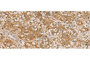 Immunohistochemistry of paraffin-embedded Human liver cancer tissue using QDPR Polyclonal Antibody at dilution of 1:70(x200) (QDPR 抗体)