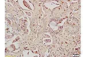 Formalin-fixed and paraffin embedded human rectal carcinoma labeled with Anti-Caspase-8 Polyclonal Antibody, Unconjugated (ABIN724205) 1:200 followed by conjugation to the secondary antibody and DAB staining (Caspase 8 抗体  (AA 411-482))