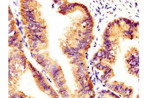 IHC image of ABIN7174056 diluted at 1:400 and staining in paraffin-embedded human endometrial cancer performed on a Leica BondTM system.