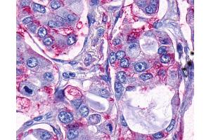 Anti-TAAR9 antibody IHC of human Lung, Adenocarcinoma. (TAAR9 抗体  (Extracellular Domain))