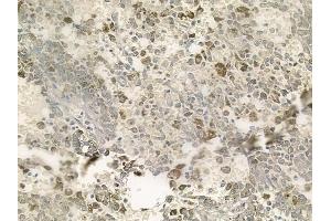 ABIN6256978 and ABIN6273749 at 1/100 staining human melanoma by IHC-P. (C9orf156 抗体  (Internal Region))